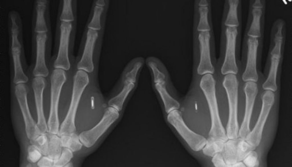 X-ray of RFID in hands
