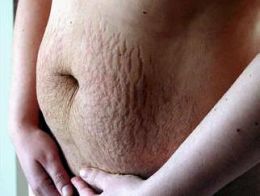 Stretchmarks